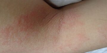 La ANMAT aprobó dos nuevos  medicamentos para la Dermatitis Atópica
