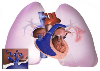 Hipertensión Pulmonar, la importancia del diagnóstico temprano