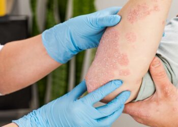 Dermatitis atópica en niños, una patología con comorbilidades asociadas