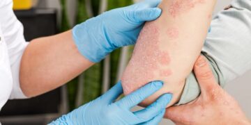 Dermatitis atópica en niños, una patología con comorbilidades asociadas
