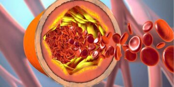 El colesterol como factor de riesgo: una problemática silenciosa