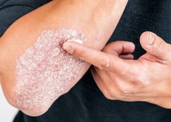 Campaña de detección gratuita de la enfermedad psoriásica