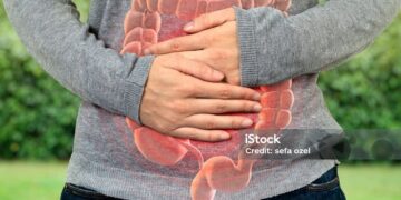 Un ensayo clínico revela un método natural y efectivo para recudir la recurrencia en el cáncer colorrectal