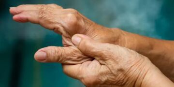 La artrosis de mano puede diagnosticarse de forma precoz para tratarse con éxito
