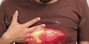 La tercera causa principal de muerte por cáncer es el hígado