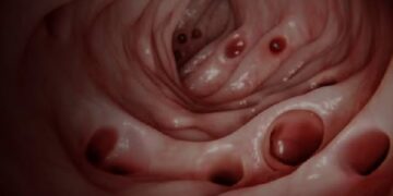 La mayoría de las personas desarrollan diverticulosis en la edad adulta