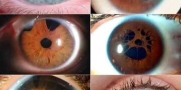 ¿Qué es la policoria y a qué organo del cuerpo afecta?