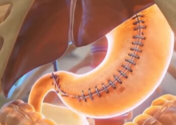 ¿Qué pasa si comes sin parar tras una manga gástrica?