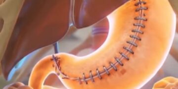 ¿Qué pasa si comes sin parar tras una manga gástrica?